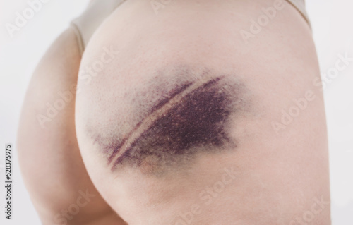 Closeup of a bruise on a woman s thigh. Large hematoma. Female buttocks with a bruise after an injury close up
