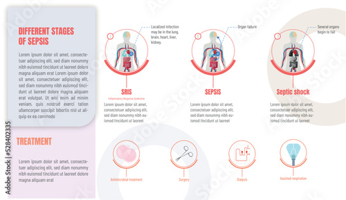 Infographics, evolution of sepsis stages and possible treatments