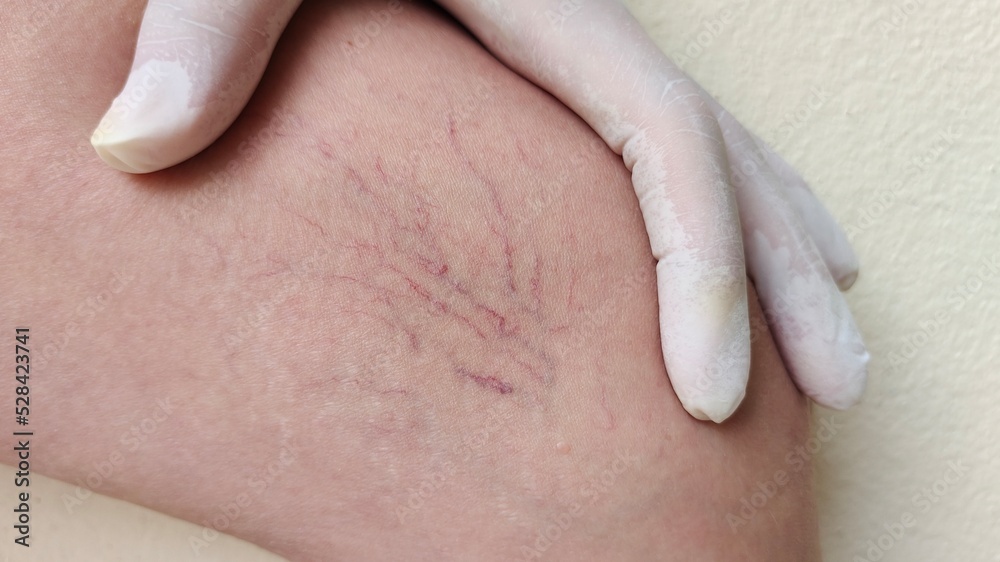 Portrait showing the hand holding the flabbiness skin and varicose veins on the leg, circulation of blood, problem wrinkle and Inflammation skin of the patient woman, concept health care. Portrait showing the hand holding the flabbiness skin and varicose veins on the leg, circulation of blood, problem wrinkle and Inflammation skin of the patient woman, concept health care.
