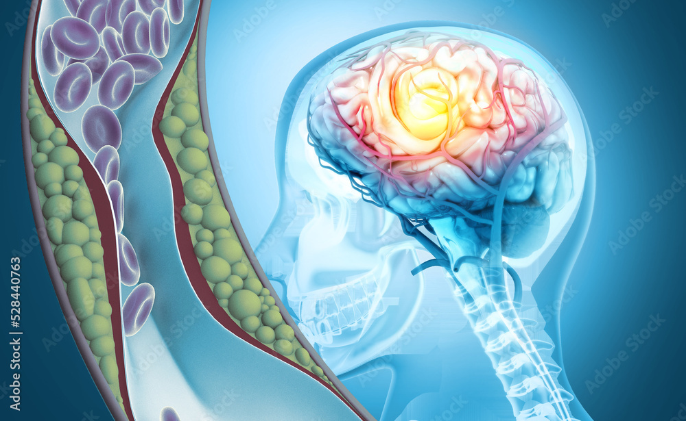 Stroke. A blood clot in the vessels of the human brain. Human anatomy