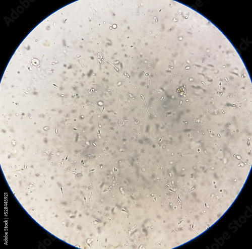 Semen analysis under microscopy showing Pyospermia or leukocytospermia. Sperm analysis. photo