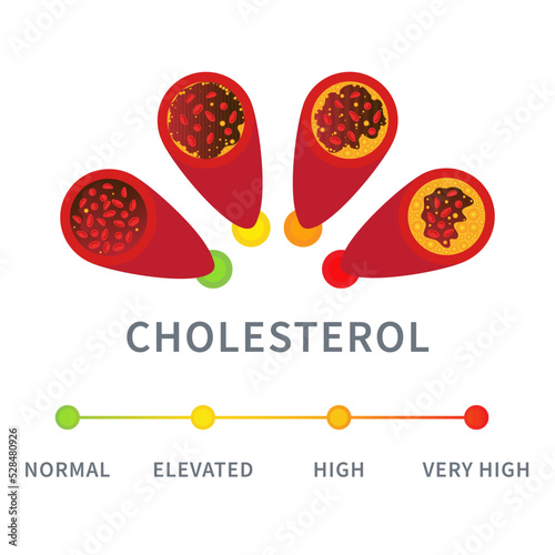 Cholesterol level in blood vessel medical diagram. Meter gauge of atherosclerosis in coronary artery. ldl and hdl lipoprotein. High and low fat test indicator. Healthcare concept. Vector illustration.