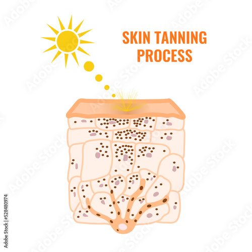 Skin epidermis cross-section showing change in melanin distribution in tanned skin. Sun rays and pigment darkening. Hyperpigmentation caused by ultraviolet radiation diagram. Vector illustration.