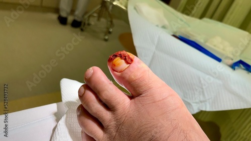 Tableau sur toile male patient with ingrown toe nail waiting for an operation