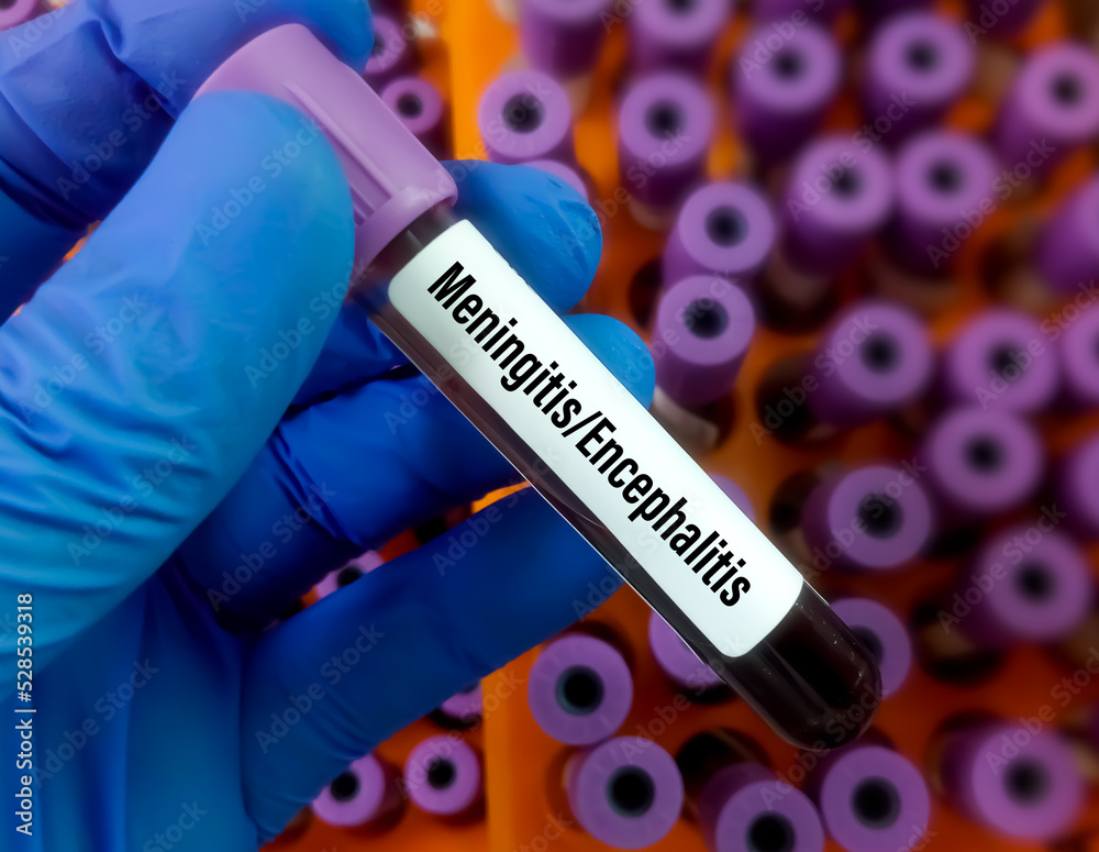 Obraz premium Scientist holding blood sample for Meningitis or Encephalitis PCR test