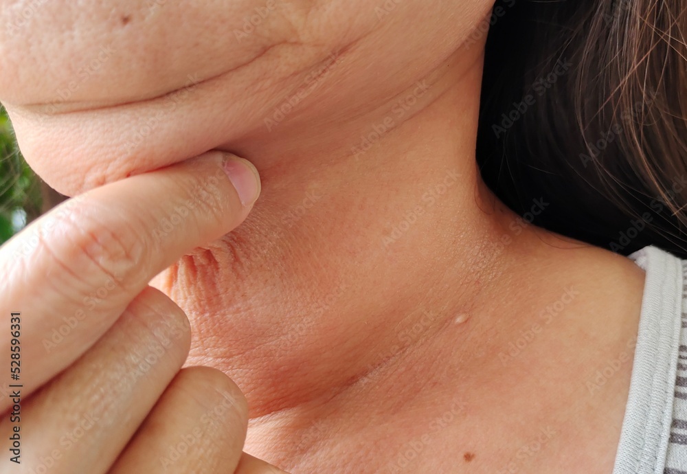 Portrait the fingers squeeze the flabbiness adipose hanging skin under the neck, dull skin and cellulite on the body, problem Wrinkled and flabby skin under the chin of the woman, concept health care.