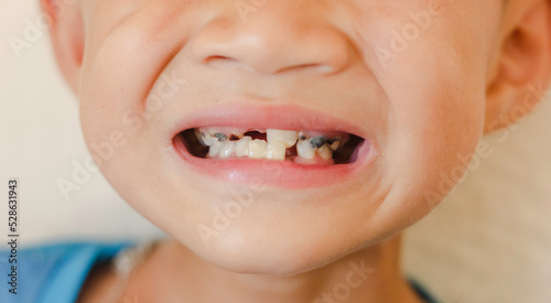 young  boy smile with a dental, Tooth dental close up caries extensive early dental caries, dentist teeth with black and white