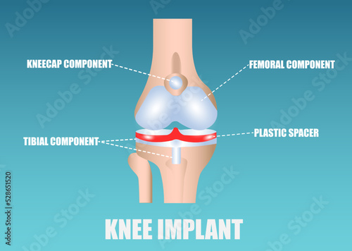 Vector of a knee implant