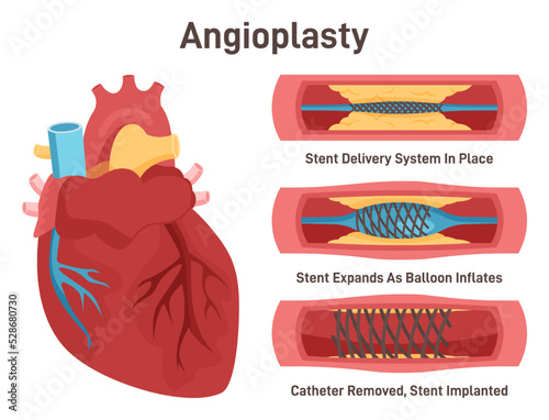 Angioplasty. Stent delivery and implantation. Deflated balloon catheter