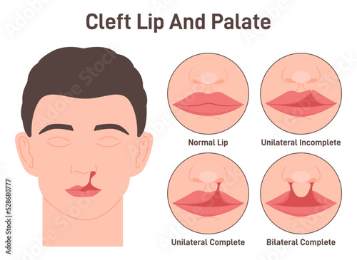 Cleft lip and cleft palate. Harelip. Human face with a birth defect.
