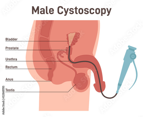 Cystoscopy. Male bladder surface examination with a flexible cystoscope