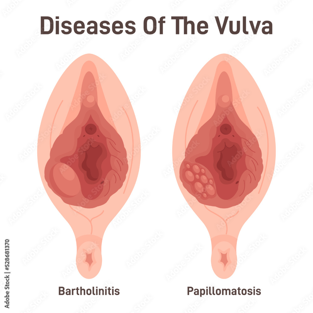 Bartholinitis and papillomatosis. Female reproductive system diseases.