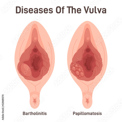Bartholinitis and papillomatosis. Female reproductive system diseases. photo