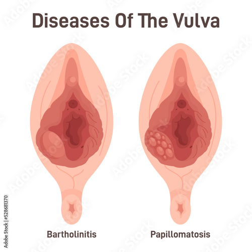 Bartholinitis and papillomatosis. Female reproductive system diseases.