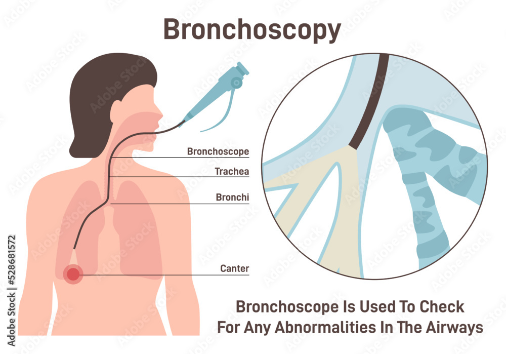 Bronchoscopy. Human respiratory system examination. flexible ...