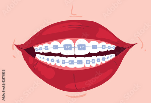Wide female smile with braces with red lips. Clean teeth with mouthwash in flat design. Smiling teeth cartoon dental care. Oral healthcare with mouthwash for plaque prevention and fresh breath.