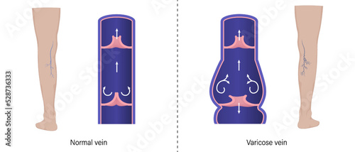 Comparison between normal veins and varicose veins in cross-sectional form. Vector for use in scientific study and medical treatment. photo