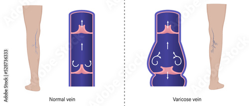 Comparison between normal veins and varicose veins in cross-sectional form. Vector for use in scientific study and medical treatment.