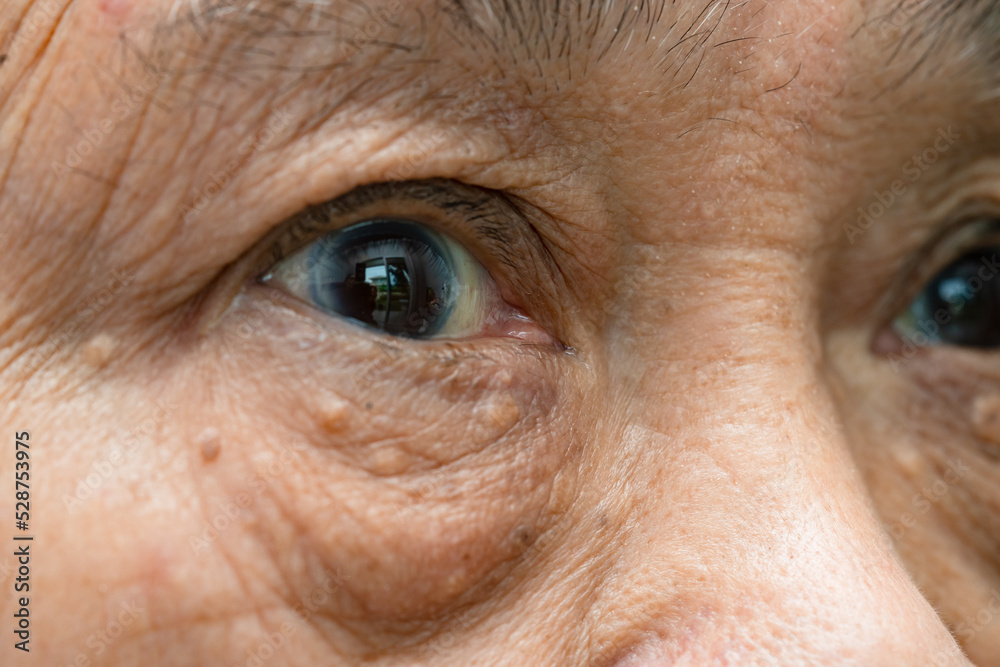 Asian elderly woman face and eye with wrinkles, portrait closeup view. Asian elderly woman face and eye with wrinkles, portrait closeup view.