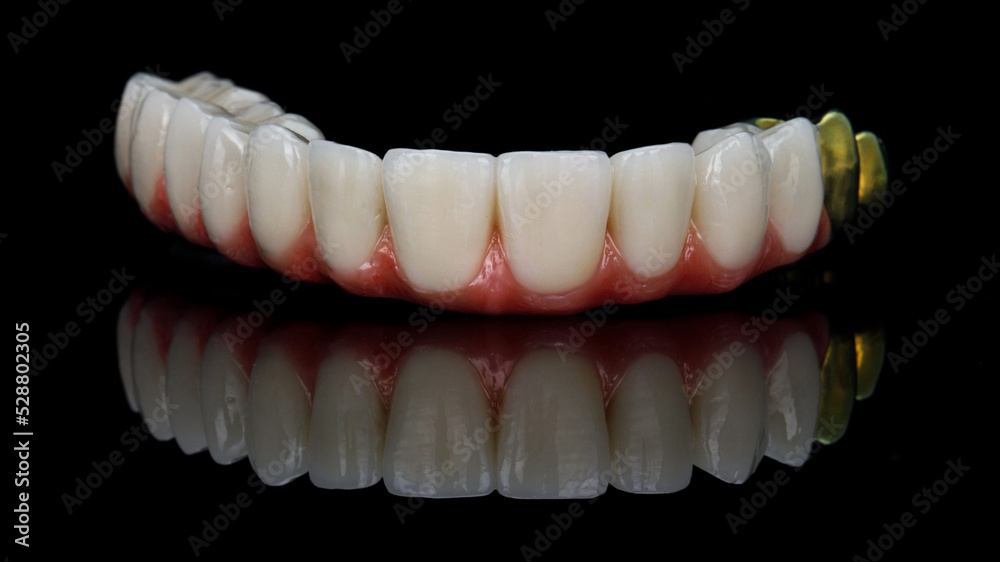 hybrid dental prosthesis of the upper jaw on a black background with creative reflection hybrid dental prosthesis of the upper jaw on a black background with creative reflection