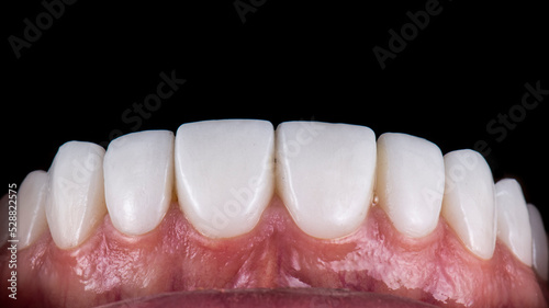 dental job photography, crowns veneers implants