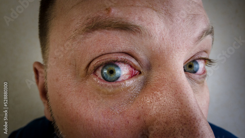 a man with red eyes sick with conjunctivitis looks at the camera close up. High quality photo