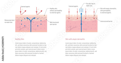 Infographic of healthy skin and skin with atopic dermatitis, how external factors and hydration affect the skin.