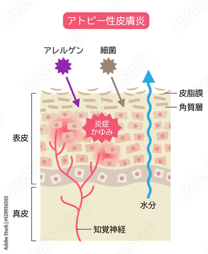 アトピー性皮膚炎のしくみ　肌細胞と断面図