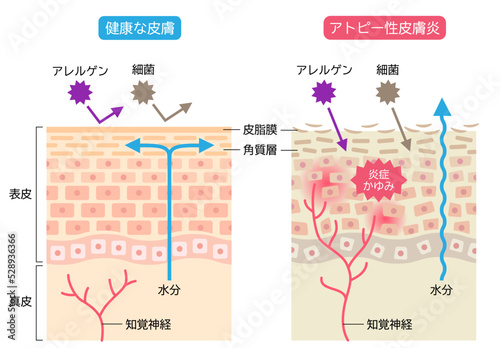 アトピー性皮膚炎と健康な皮膚　肌細胞と断面図 photo