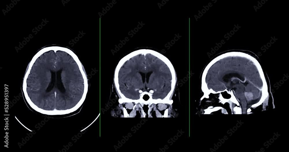CT scan of the brain with contrast media Axial , Coronal and sagittal ...