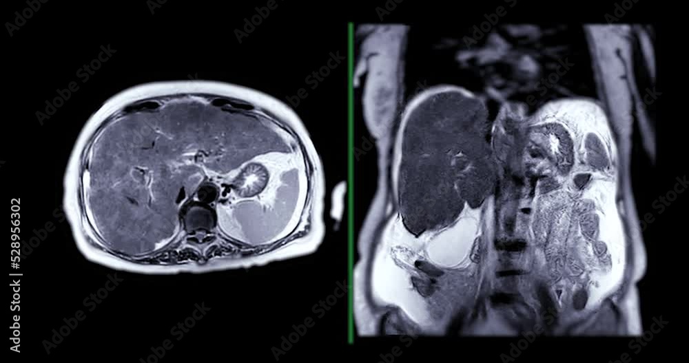 Magnetic resonance cholangiopancreatography or MRCP axial and coronal T2W view showing visualize the biliary and pancreatic ducts .