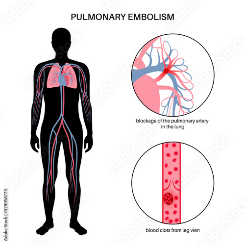 Pulmonary embolism disease