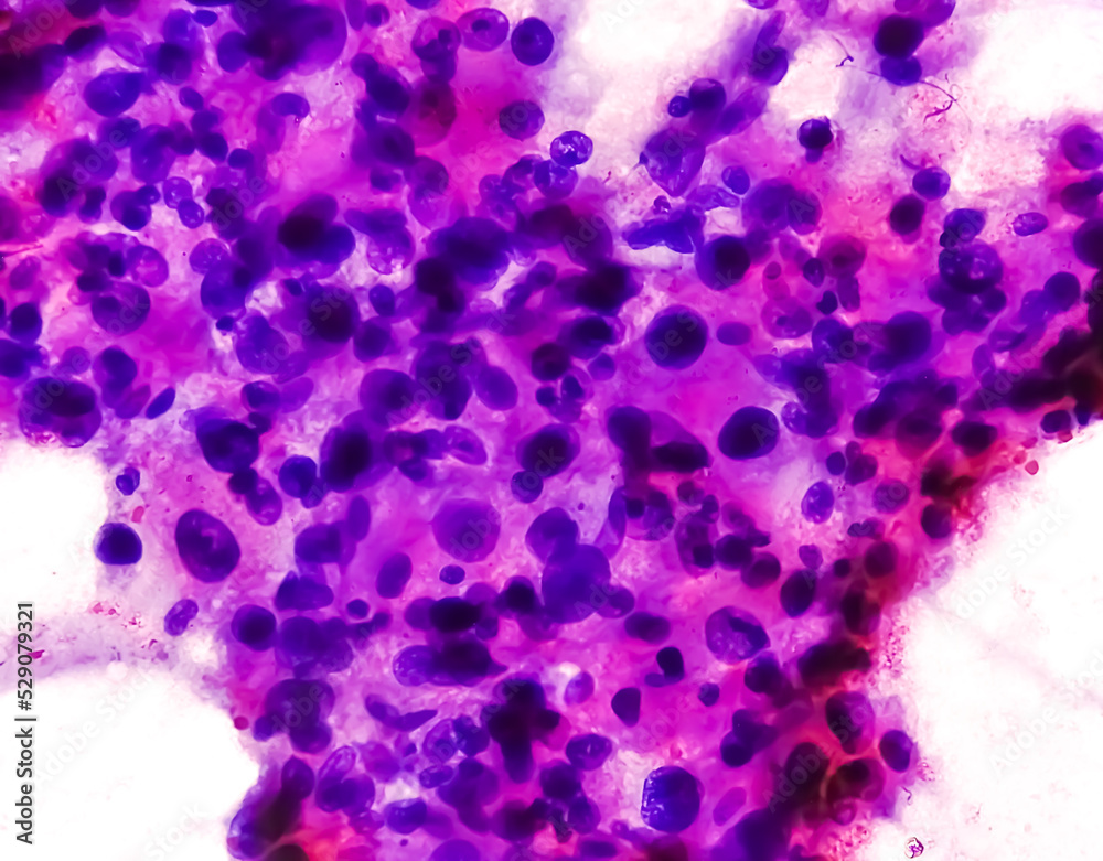 Spindle Cell an extremely rare bone cancer. Photomicrograph of