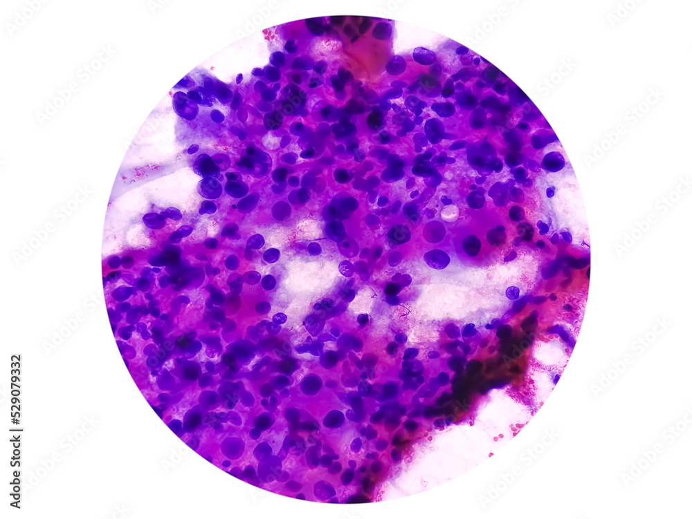 Spindle Cell Sarcoma: an extremely rare bone cancer. Photomicrograph of soft tissue tumor cytology.