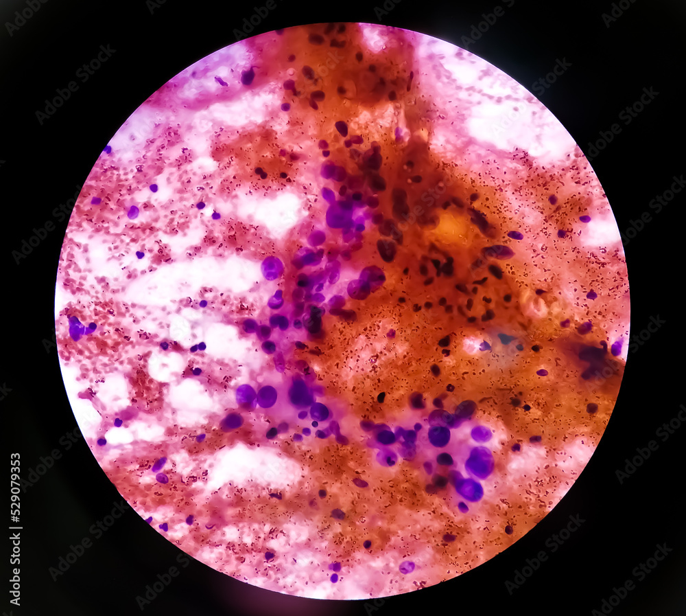 Spindle Cell an extremely rare bone cancer. Photomicrograph of soft tissue tumor