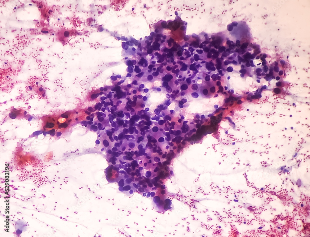 Intra abdominal mass(Cytology) Spindle cell positive