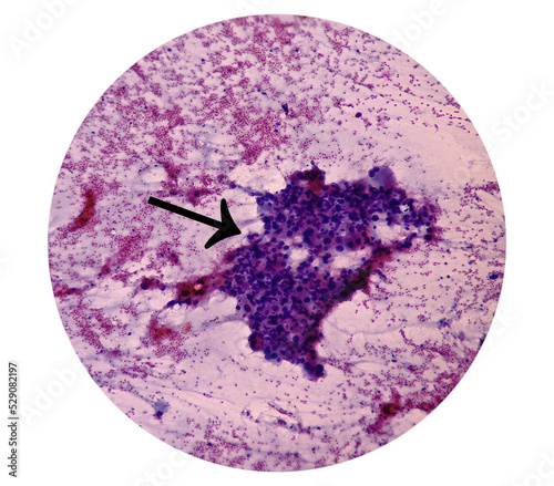 Intra abdominal mass(Cytology): Spindle cell sarcoma, positive malignant cells. Pleomorphic undifferentiated sarcoma, malignant fibrous histiocytoma. photo