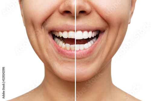 Cropped shot of a young caucasian smiling woman before and after veneers installation isolated on a white background. Teeth whitening. Dentistry, dental treatment. Comparison of the shape of teeth photo