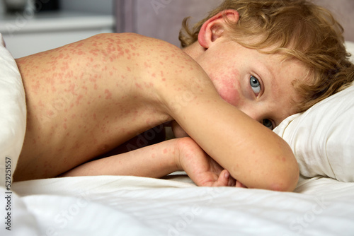 Sad look of a sick child covered in a red rash and lying on a bed under a blanket. A little boy is more rubella, lying in bed on his stomach photo