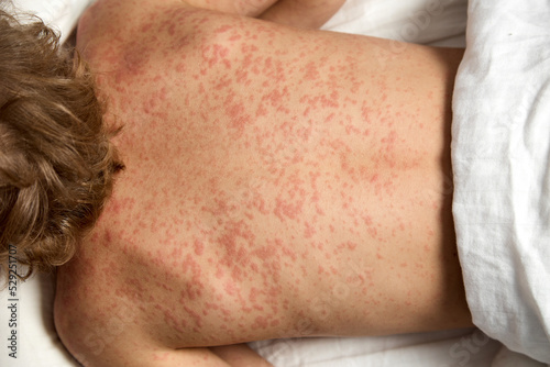 View from above the back of a child suffering from exacerbation of atopic dermatitis on the body. Severe allergic rash covered the body of a little boy photo
