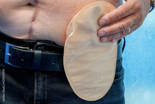 Senior with a stoma bag. Close-up of a colostomy bag photo