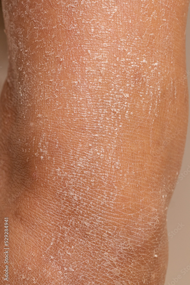 Fototapeta premium Leg of woman with dry and dehydrated skin