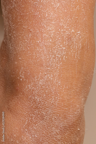 Leg of woman with dry and dehydrated skin