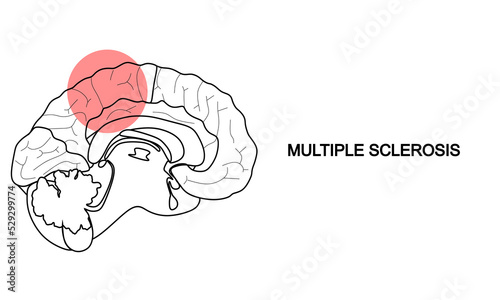 Multiple sclerosis banner. Multiple sclerosis banner design from Diseases collection. Simple element vector illustration on white background.