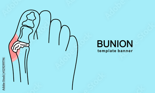 Bunion in foot Template banner. Abstract minimal illustration of foot with red spot on hallux suffers from pain. Design template for medicine or therapy for valgus deformity or bunion.