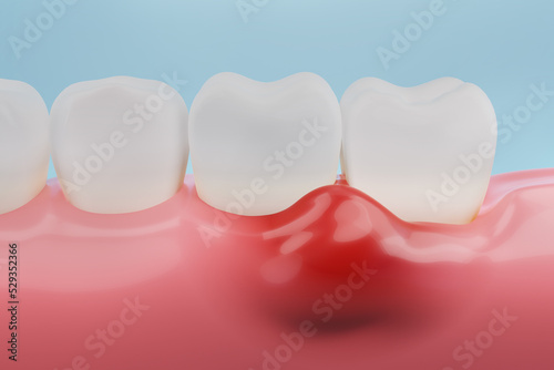 Gums inflammation, gingival recession. Dental treatment concept. 3D rendering. photo