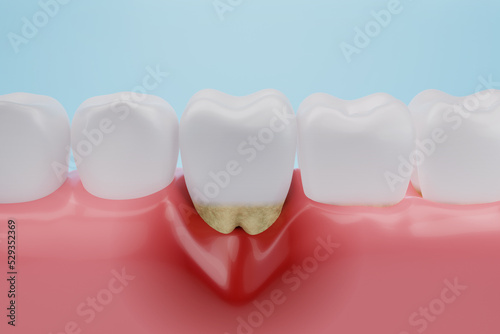 Papier peint Gum disease, Gingival Recession or inflammation for dental clinic and treatment