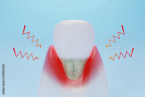 Gingival Recession or inflammation for dental clinic and treatment. 3D rendering. photo