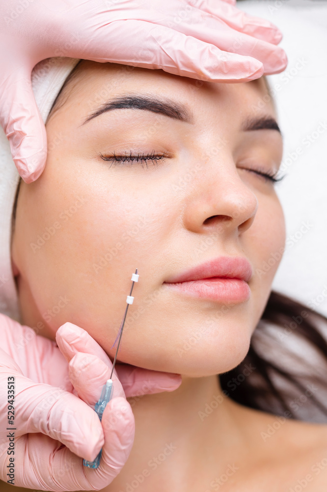 Face lifting PDO Suture operation. innovative technique of New thread