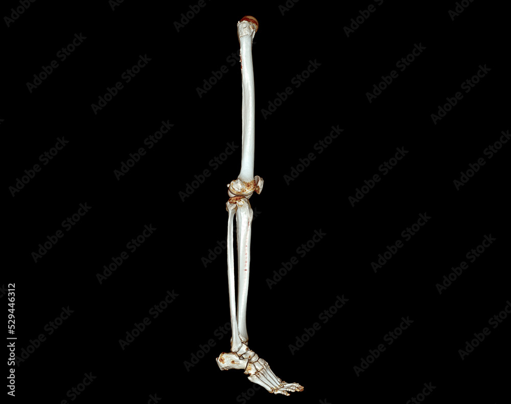 CT scan of lower extremity 3D . CT scan of lower extremity 3D .